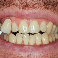 Teeth Whitening - Smile 4 before